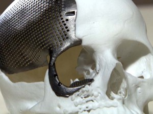 Unicamp faz 1ª cirurgia de crânio com titânio impresso em 3D do Brasil